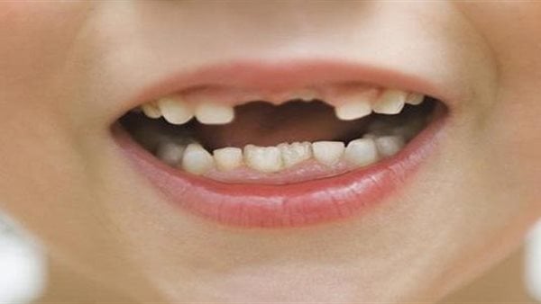 أطعمة شائعة تضر بصحة الأسنان.. تعرف عليها