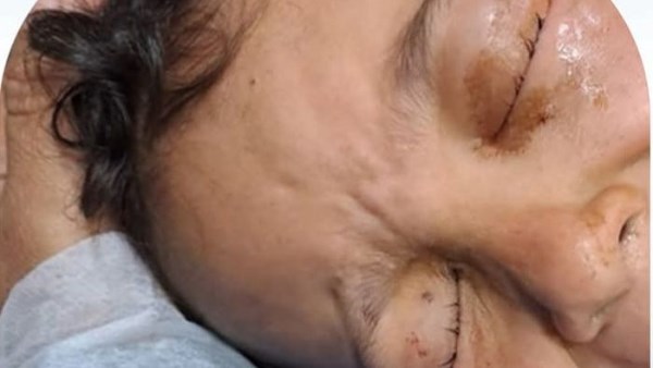 معجزة طبية في دسوق .. فريق أطباء ينقذ بصر 3 أطفال أشقاء من العمى