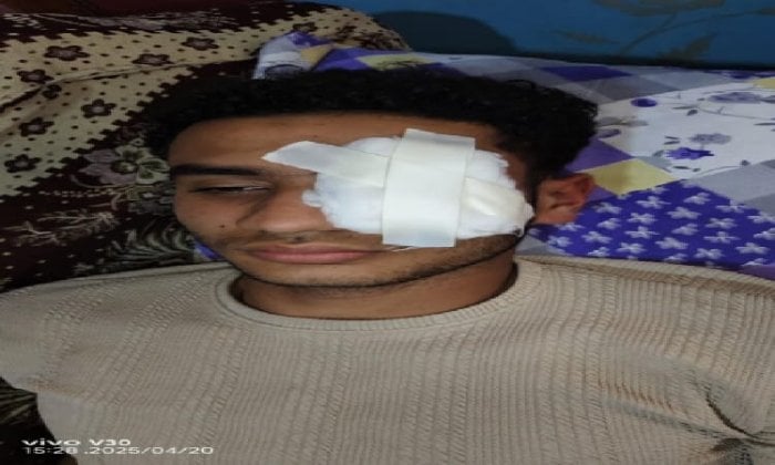 شاب يفقد بصره على يد آخر بسبب مشادة لفظية في عزبة الفار بطنطا
