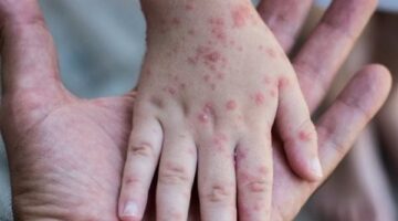 بعد أمريكا.. انتشار الحصبة في مقاطعة بريطانية