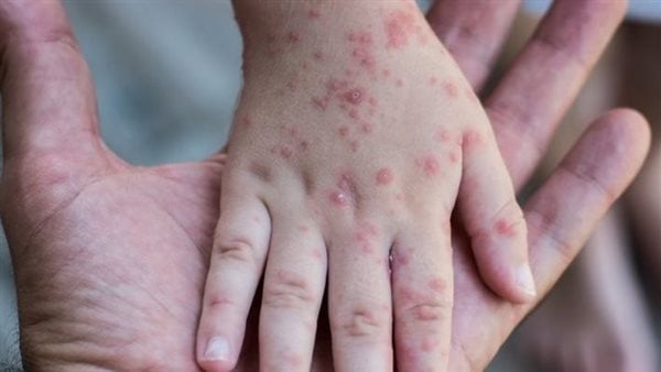 بعد أمريكا.. انتشار الحصبة في مقاطعة بريطانية