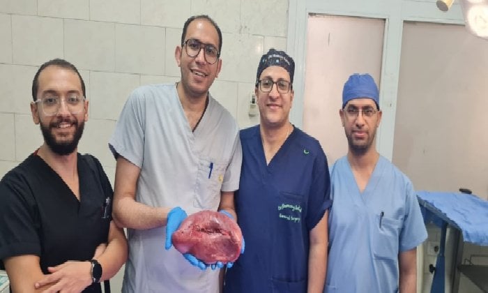 استئصال طحال متضخم يزن 2 كيلو من مريضة بمستشفى أسيوط العام