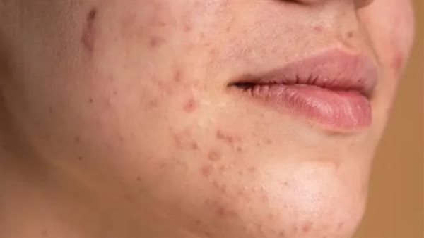هذا الحمض يعالج مشاكل البشرة