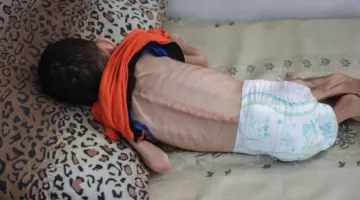 طفل في غزة يتوفى نتيجة نقص التغذية