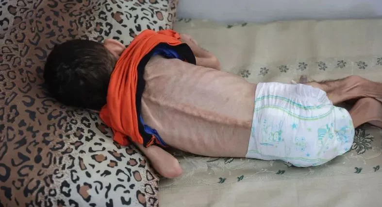 طفل في غزة يتوفى نتيجة نقص التغذية طفل في غزة يتوفى نتيجة نقص التغذية