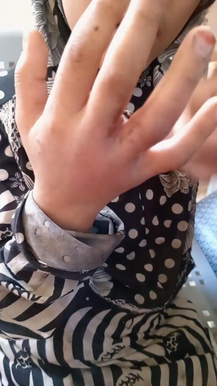 الطفلة ضحية تعذيب والدها في الوادى الجديد