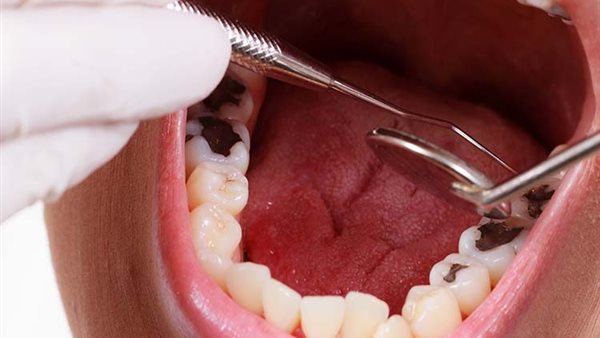 علماء روس يطورون طلاء للأسنان يحمي من التسوس