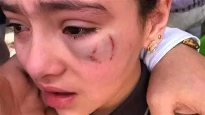 تصالح بين أسرة الطفلة “حنين” والمعلم بعد إصابتها في عينها داخل مدرسة بالدقهلية