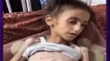 الأمم المتحدة: شخص من كل 5 في غزة يعاني من الجوع المباشر