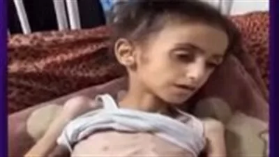 الأمم المتحدة: شخص من كل 5 في غزة يعاني من الجوع المباشر الأمم المتحدة: شخص من كل 5 في غزة يعاني من الجوع المباشر