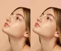 تقنية تجميلية لصيف مثالي: تصغير الأنف بدون جراحة بنتائج فورية وطبيعية