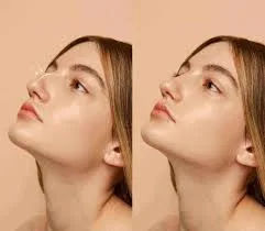تقنية تجميلية لصيف مثالي: تصغير الأنف بدون جراحة بنتائج فورية وطبيعية