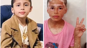 كنت جميلة قبل الحرب: لانا الشريف، طفلة فلسطينية تأثرت بالاحتلال وظهور البهاق نتيجة للخوف