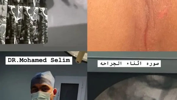 لأول مرة في الدقهلية.. إجراء ناجح لعملية دقيقة لترميم كسر في العنق بتمي الأمديد لأول مرة في الدقهلية.. إجراء ناجح لعملية دقيقة لترميم كسر في العنق بتمي الأمديد