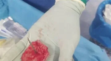 نجاح طبي غير عادي في جامعة الفيوم: إزالة مسمار من جمجمة طفل دون التأثير على المخ