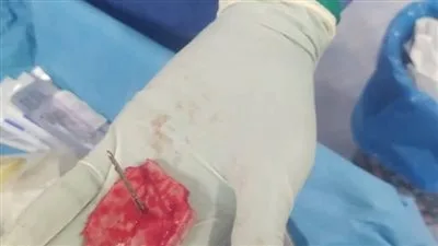 نجاح طبي غير عادي في جامعة الفيوم: إزالة مسمار من جمجمة طفل دون التأثير على المخ نجاح طبي غير عادي في جامعة الفيوم: إزالة مسمار من جمجمة طفل دون التأثير على المخ