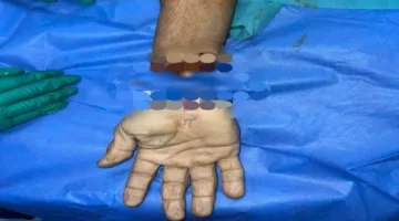 طب طنطا يتمكن من إعادة توصيل يد مقطوعة بعد 3 ساعات من انفصالها