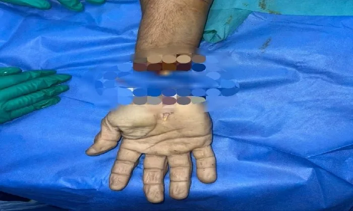 طب طنطا يتمكن من إعادة توصيل يد مقطوعة بعد 3 ساعات من انفصالها طب طنطا يتمكن من إعادة توصيل يد مقطوعة بعد 3 ساعات من انفصالها