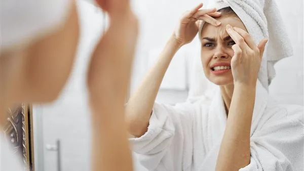 أبرزها الجبن والشوكولاتة.. أطعمة مسببة لحب الشباب تعرف عليها