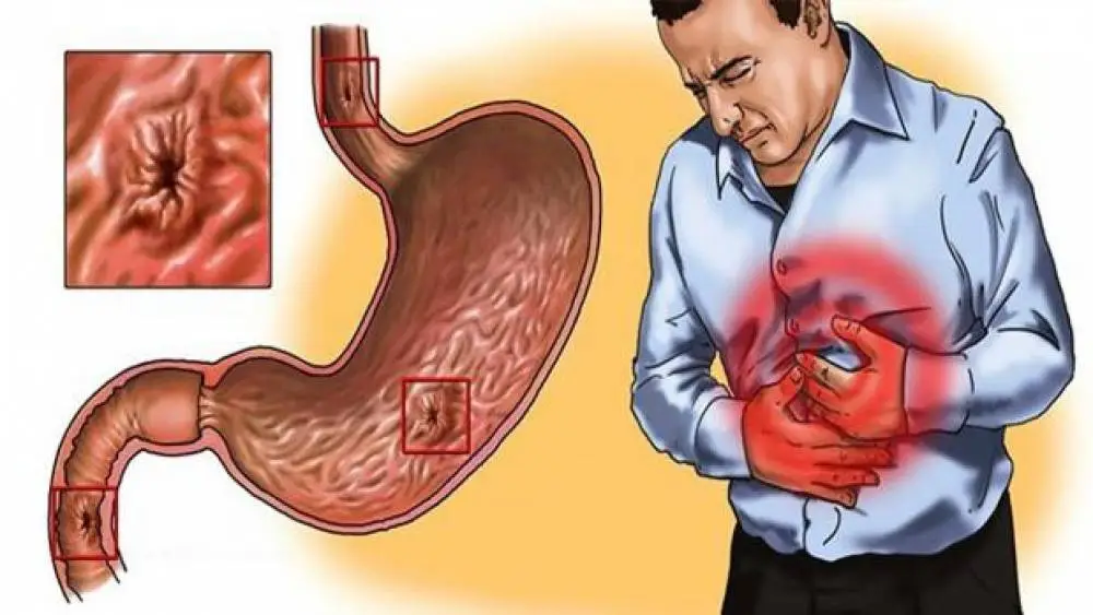 إليك أسرع علاج جرثومة المعدة في مصر | مركز اندوسكوب