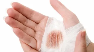ابتكار تركيبة تسهم في شفاء جروح الأنسجة الرخوة بالجسم