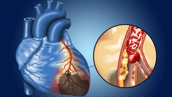 اكتشاف آلية غير متوقعة وراء تلف القلب بعد النوبات