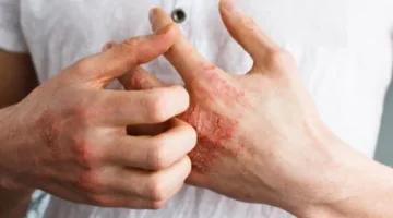 الإكزيما: حالة جلدية تؤثر على 20% من الأطفال.. كيف نحافظ على صحة أطفالنا؟