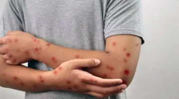 السلطات الصحية الإسبانية تحذر من خطر الإصابة بالحصبة وتحث المواطنين على التطعيم