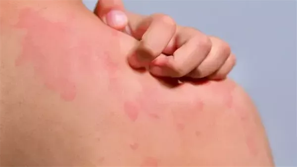 الطفح الجلدي قد يكون جرس إنذار لأمراض خفية