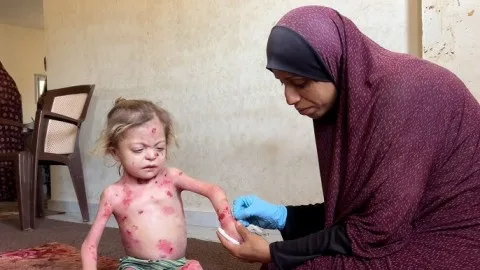 الطفلة “نور” في غزة: مرض “الفراشة” يؤثر على جسدها النحيف والجائع الطفلة “نور” في غزة: مرض “الفراشة” يؤثر على جسدها النحيف والجائع