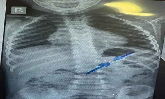 باستخدام منظار الأطفال دون مضاعفات.. فريق طبي بمستشفى سوهاج الجامعي ينجح في استخراج دبوس من معدة طفل