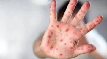 تسجيل 9 حالات جديدة من الحصبة في تكساس وزيادة إجمالي الحالات إلى 738