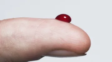 تغيرات جلدية قد تشير إلى احتمال إصابتك بمرض السكري قريبًا.