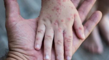 تكساس تسجل 6 إصابات جديدة بالحصبة.. الإجمالي يصل إلى 728
