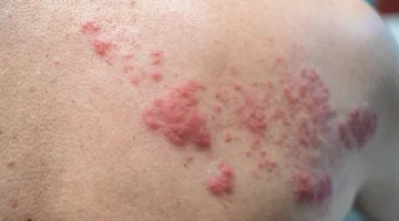 حملات توعوية لتصحيح المفاهيم الخاطئة بشأن الحزام الناري وتعزيز الوعي بوسائل الوقاية منه