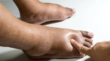 خبيرة تنبه من أضرار الوذمة
