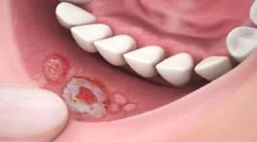 د. الأبجيجي: قرح الفم ليست دائمًا عرضًا بسيطًا وقد ترتبط بمشكلات مناعية