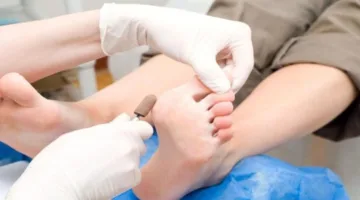 دراسة: فطريات الجلد تساعد فى مكافحة البكتيريا المقاومة للمضادات الحيوية