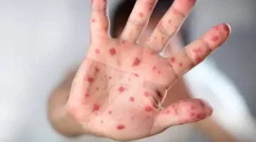 زيادة إصابات جدري القردة بنسبة 71% في سيراليون خلال سبعة أيام