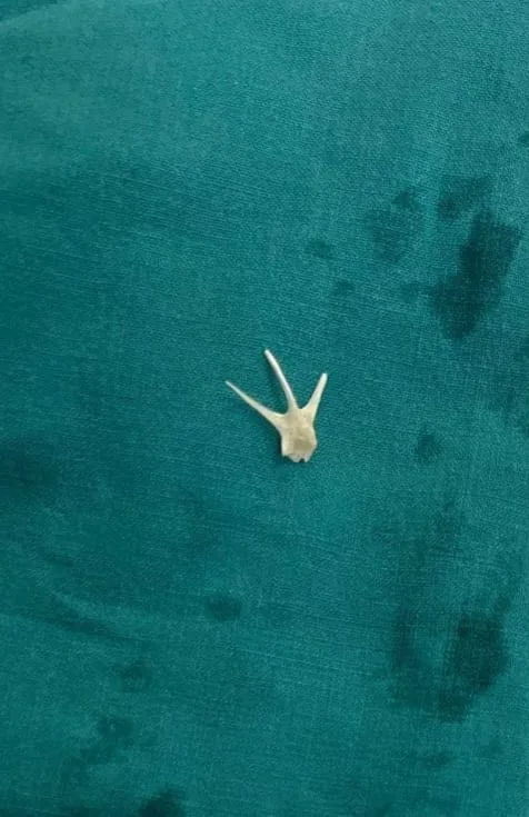 فريق طبي في جامعة سوهاج يتمكن من إزالة شوكة سمكة من مجرى الهواء لطفل. فريق طبي في جامعة سوهاج يتمكن من إزالة شوكة سمكة من مجرى الهواء لطفل.