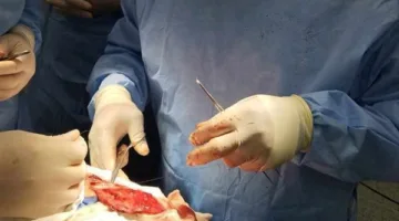 فريق طبي في مستشفى العامرية العام يحقق نجاحًا في إجراء جراحة دقيقة وغير تقليدية.