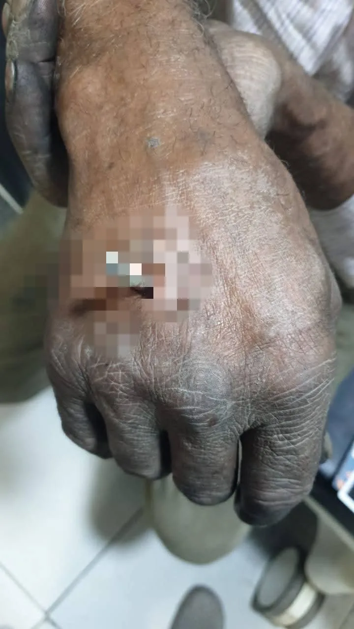 فريق طبي ينجح في استخراج «سيخ معدني» اخترق يد حدّاد بكفر الشيخ | صور