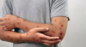 كيف أثبتت وزارة الصحة خلو مصر من الحصبة؟