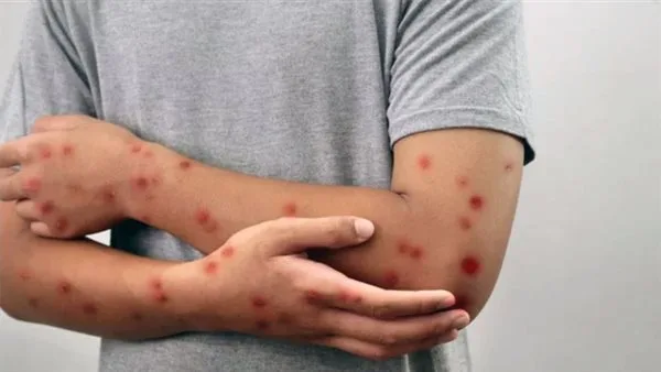 كيف أثبتت وزارة الصحة خلو مصر من الحصبة؟ كيف أثبتت وزارة الصحة خلو مصر من الحصبة؟