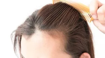 متى يشير تساقط الشعر إلى وجود عدوى جنسية خطيرة؟