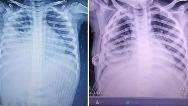 نجاح إجراء “إزالة الغشاء البلوري” لطفل في مستشفى برج العرب