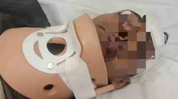 نجاح عملية جراحية دقيقة لإعادة تأهيل كسر في الرقبة في تمى الأمديد بالدقهلية