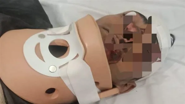 نجاح عملية جراحية دقيقة لإعادة تأهيل كسر في الرقبة في تمى الأمديد بالدقهلية نجاح عملية جراحية دقيقة لإعادة تأهيل كسر في الرقبة في تمى الأمديد بالدقهلية