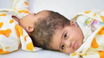 نجاح عملية فصل التوأم الإريتري “أسماء وسمية” الملتصقين