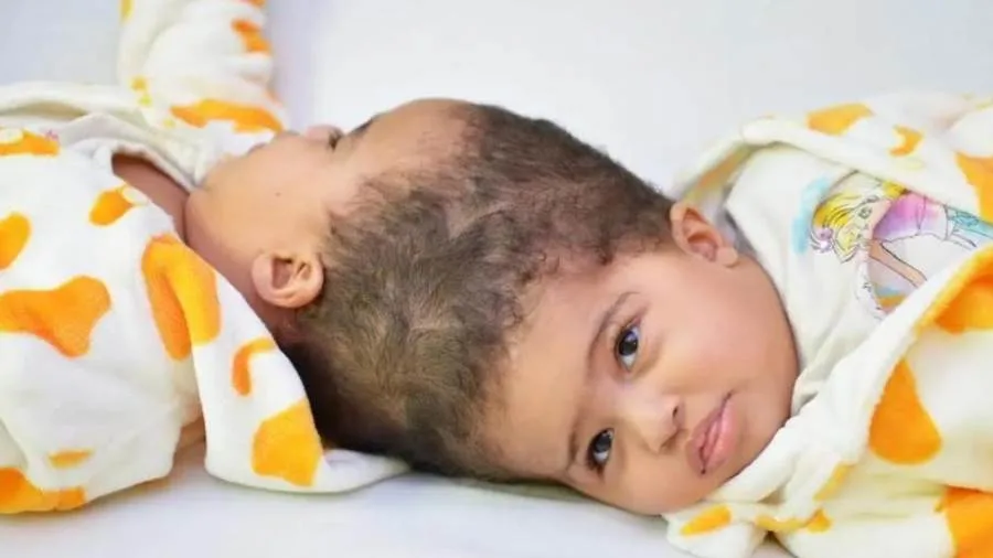 نجاح عملية فصل التوأم الإريتري “أسماء وسمية” الملتصقين